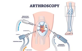 arthroscopy