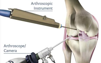arthroscopy