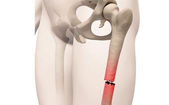 Fractures & Trauma Surgeries