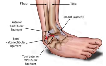 Ligament and Sports Injury 